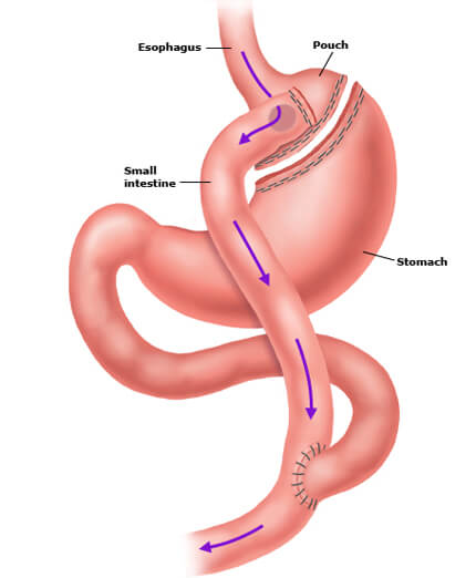 Bariatric Surgery
